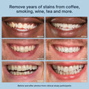 Baobab Teeth Whitening Stick — Whiter Teeth in 7 Days or Your Money Back